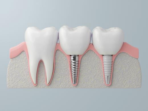 3D-Modell: Querschnitt eines Kieferausschnitts mit Zahn und verschiedenen Implantaten