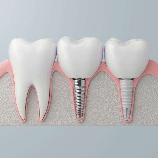 3D-Modell: Querschnitt eines Kieferausschnitts mit Zahn und verschiedenen Implantaten